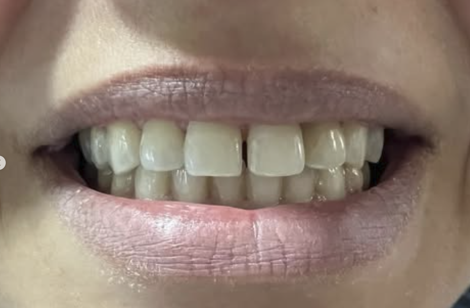 Sorriso do paciente antes do tratamento com facetas