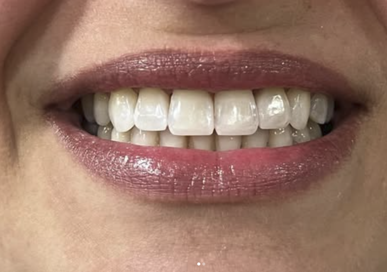 Sorriso do paciente depois do tratamento com facetas